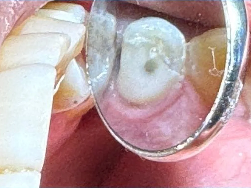 Broken Tooth Rebuilt with a Fibre Post & Composite (after)