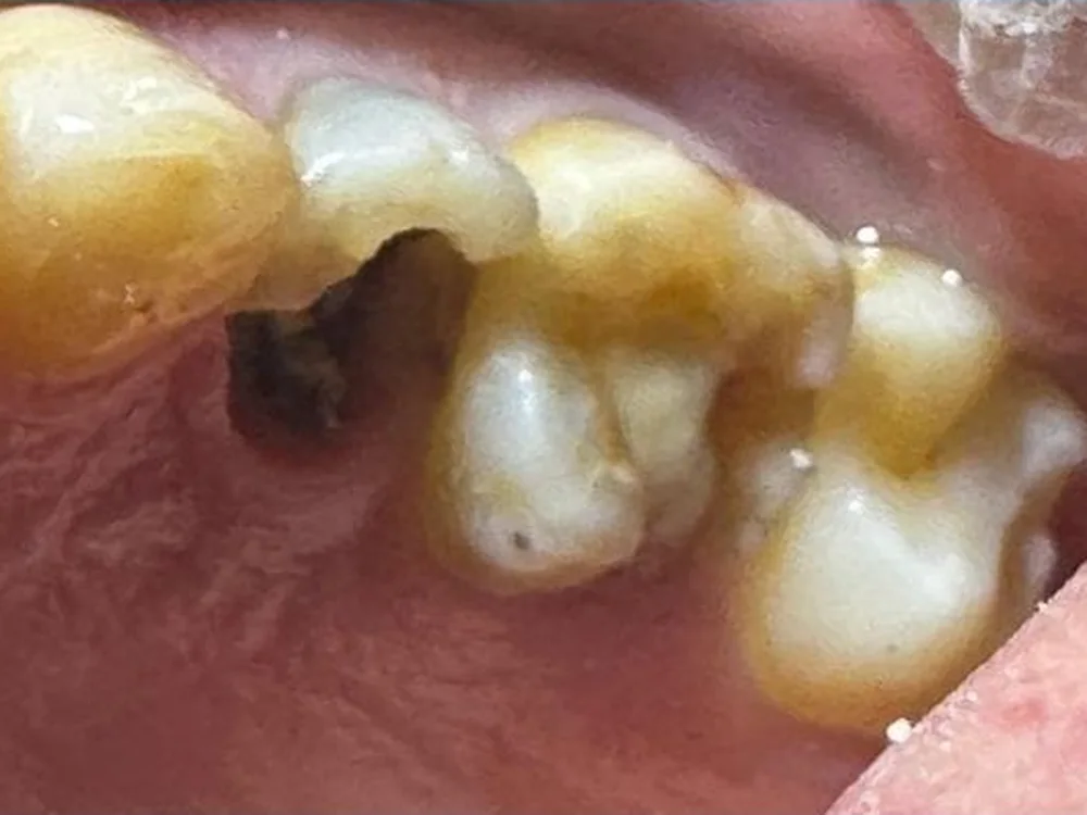 Broken Tooth Rebuilt with a Fibre Post & Composite (before)