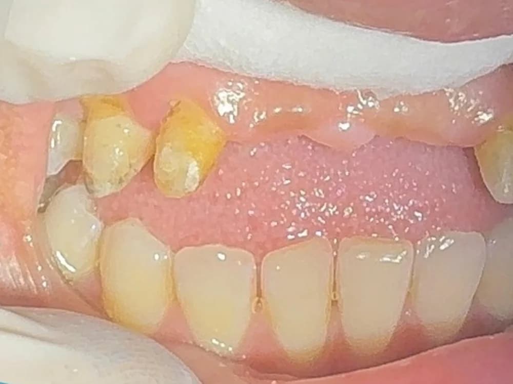 Canine-to-Canine Smile Restoration in Zirconia (before)