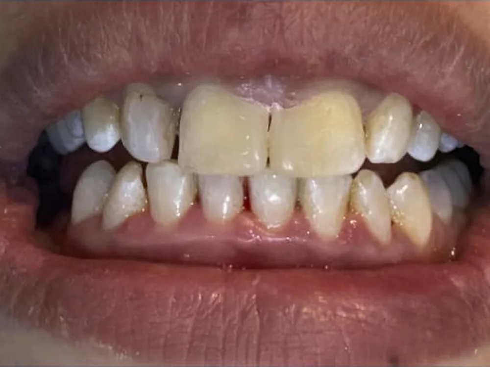 Front tooth gap after composite bonding