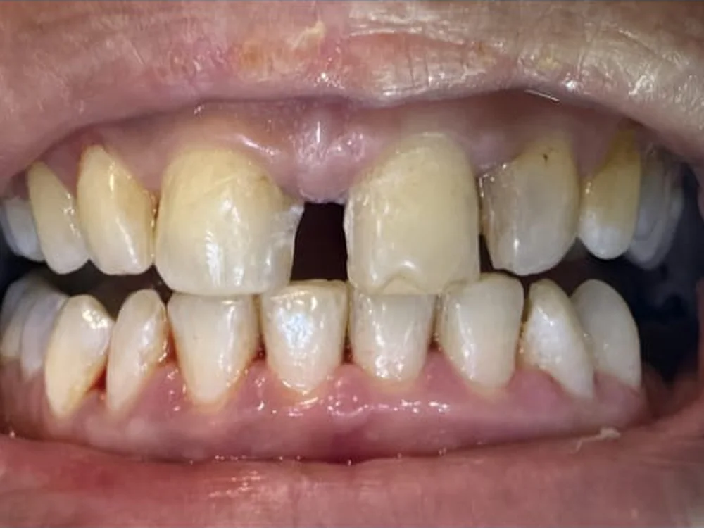Diastema Closure with Composite Bonding (before)