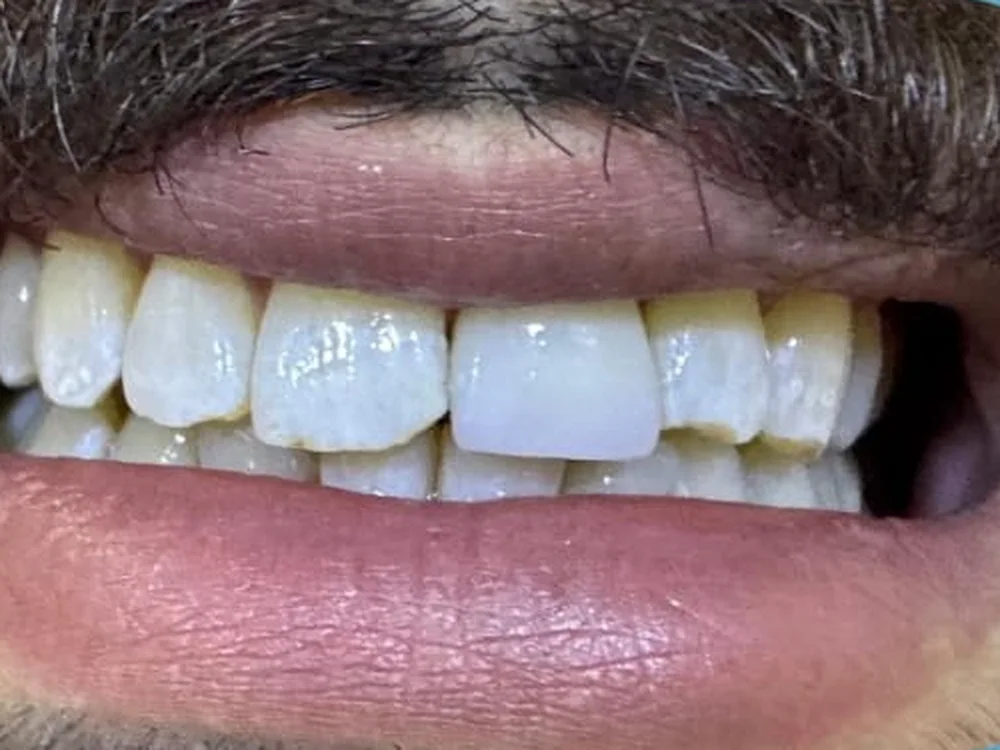 Front tooth after zirconia crown treatment
