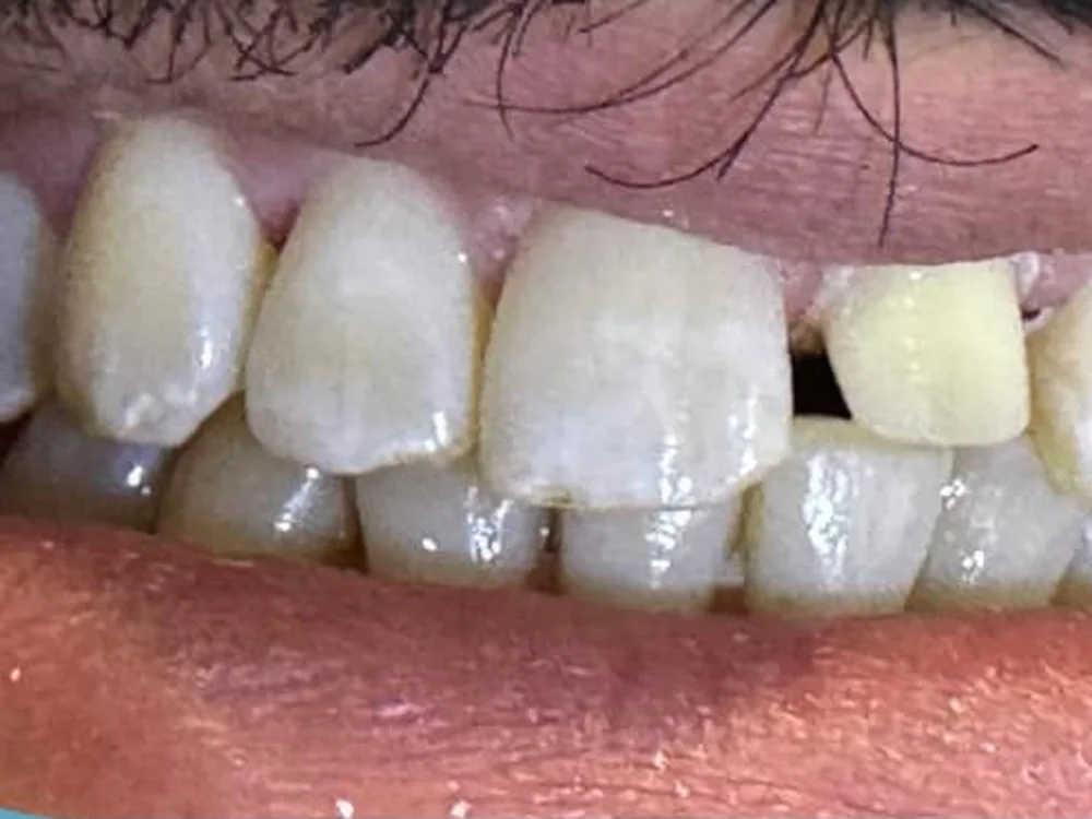 Front Tooth Restored with a Full-Contour Zirconia Crown (before)