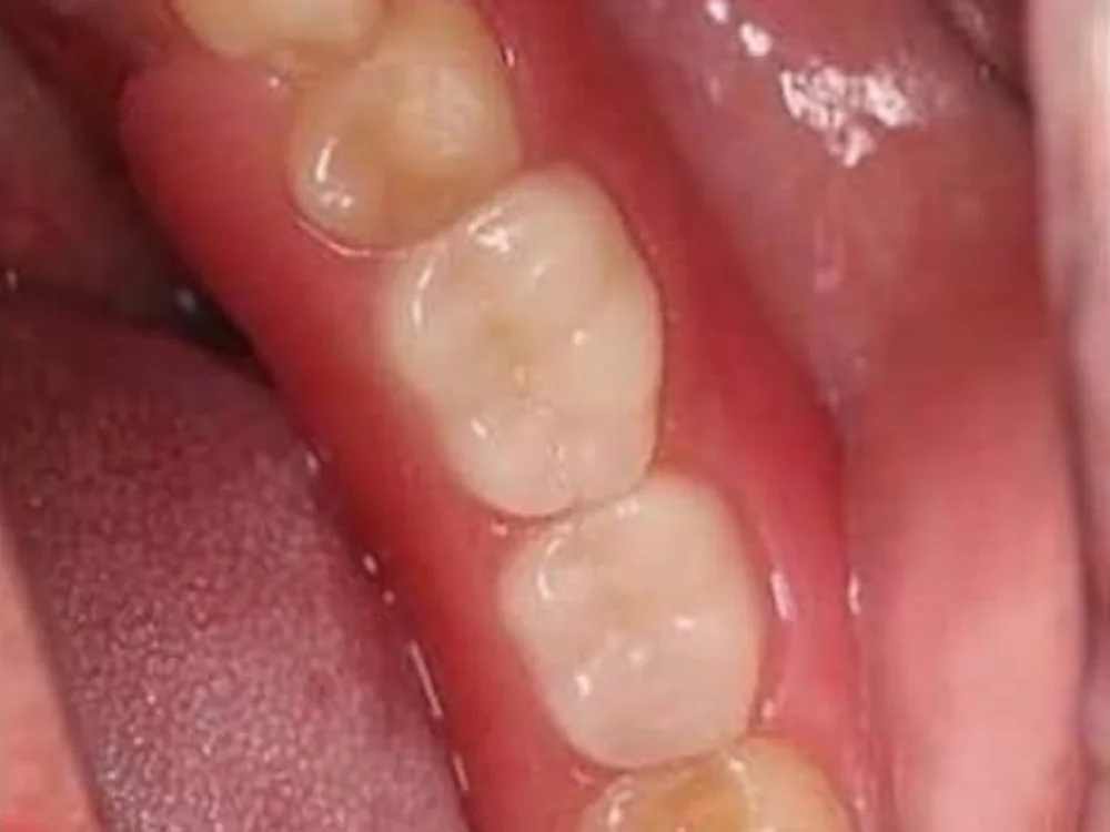 Missing Back Teeth Replaced with a Partial Denture (after)