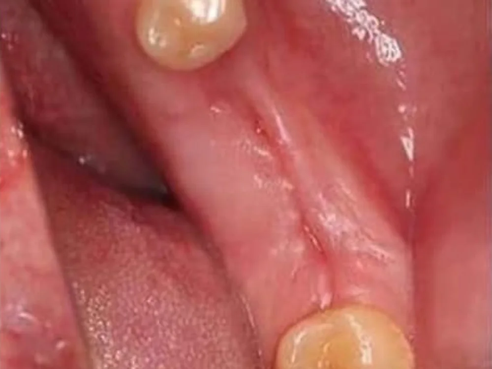Missing Back Teeth Replaced with a Partial Denture (before)