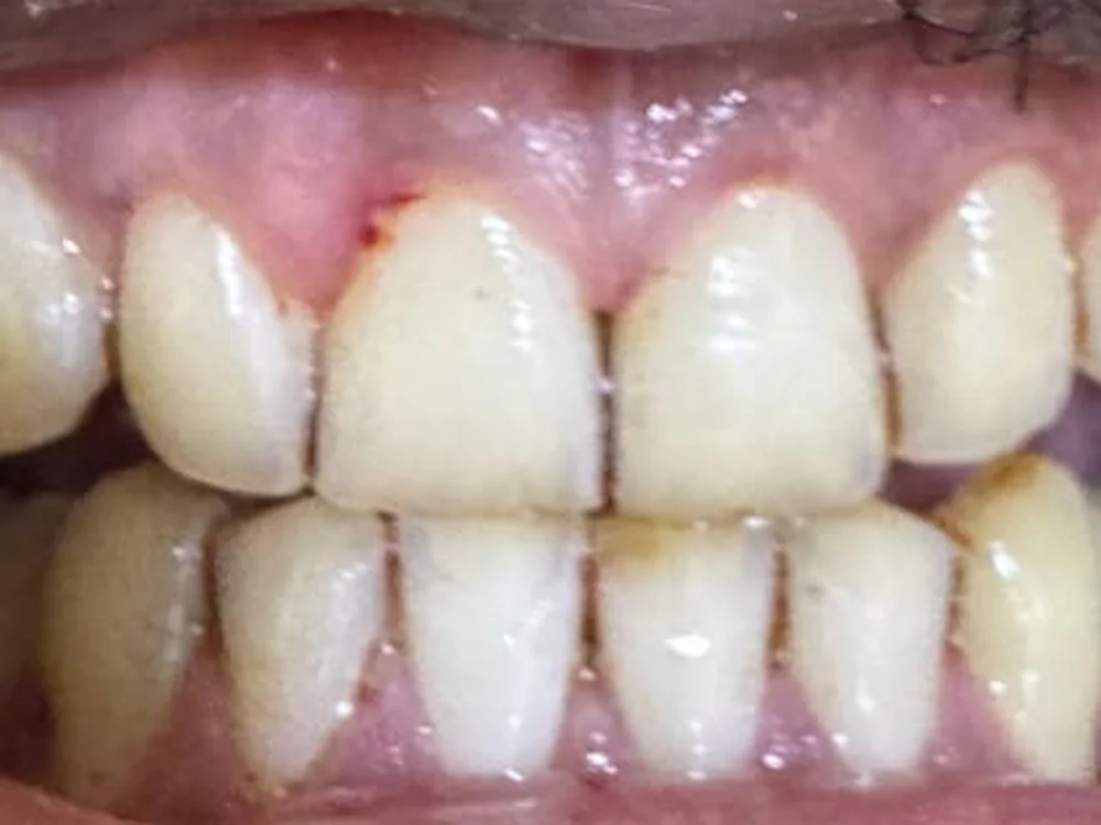 Teeth after scaling and polishing