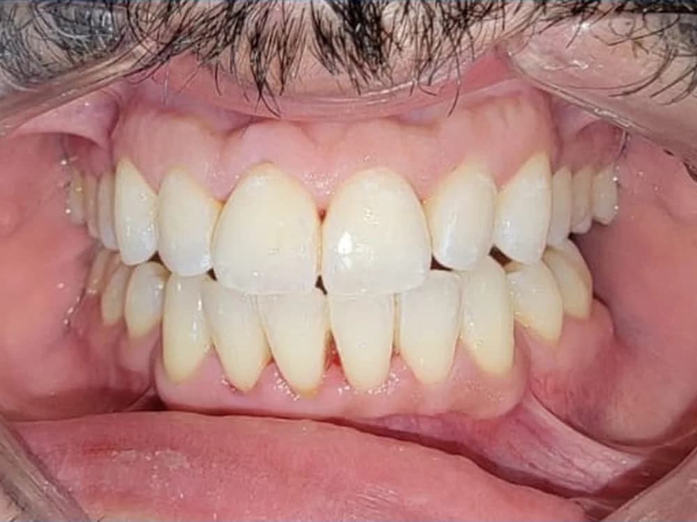 Teeth Whitening after treatment