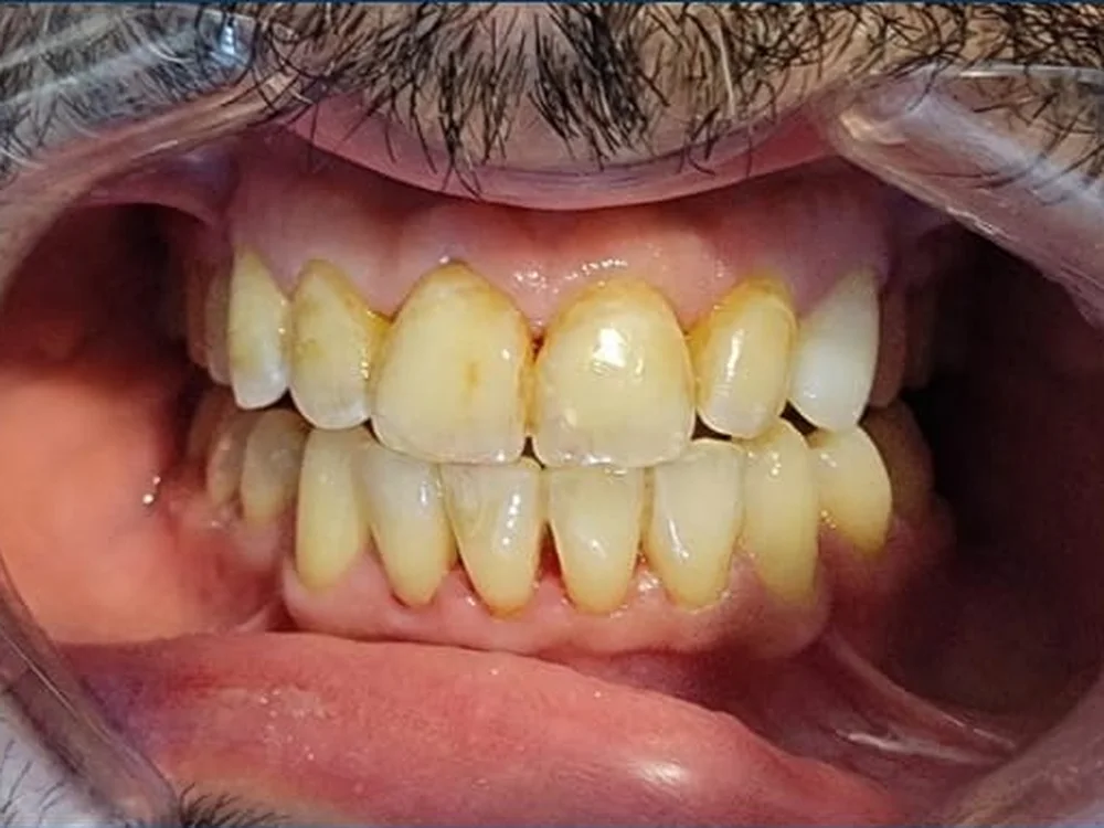Teeth Whitening before treatment