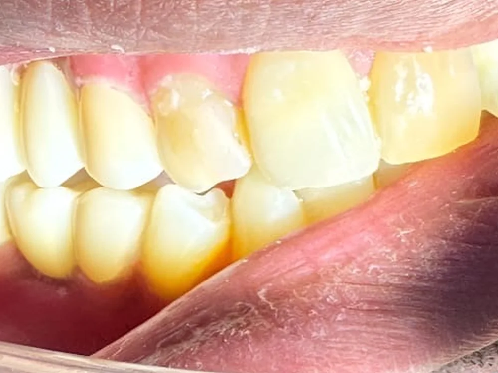 Broken-Down Back Teeth Rebuilt with a Zirconia Crown & Bridge (after)