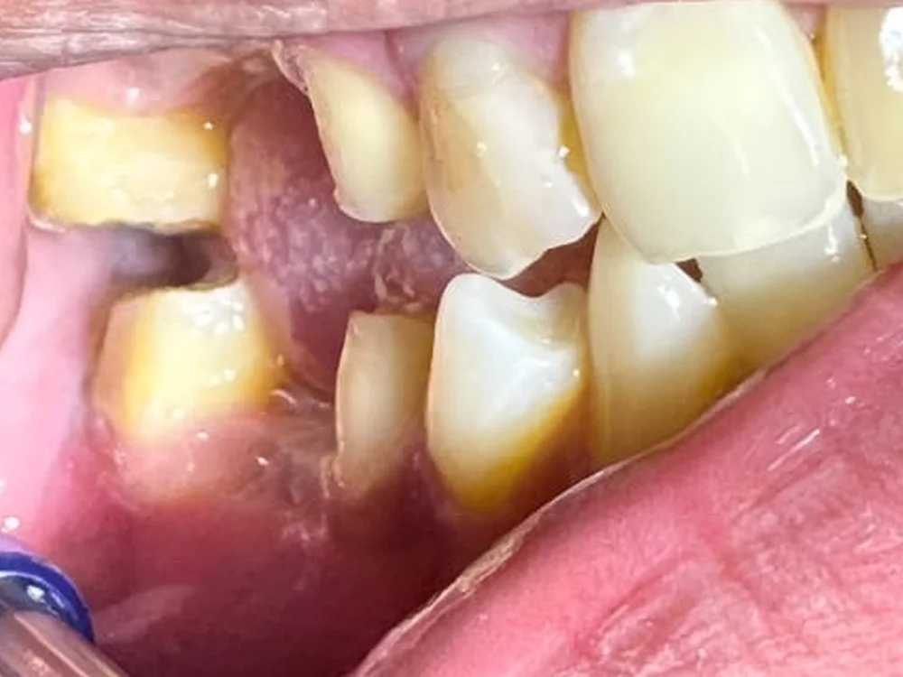 Broken-Down Back Teeth Rebuilt with a Zirconia Crown & Bridge (before)